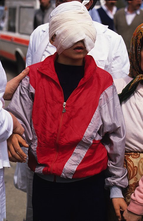 Photo of Sead Bekric, child victim of the 1993 Srebrenica Children Massacre. Shrapnel from a mortar had swept away this boy's eyes and blinded him, part of his skull was also crushed.