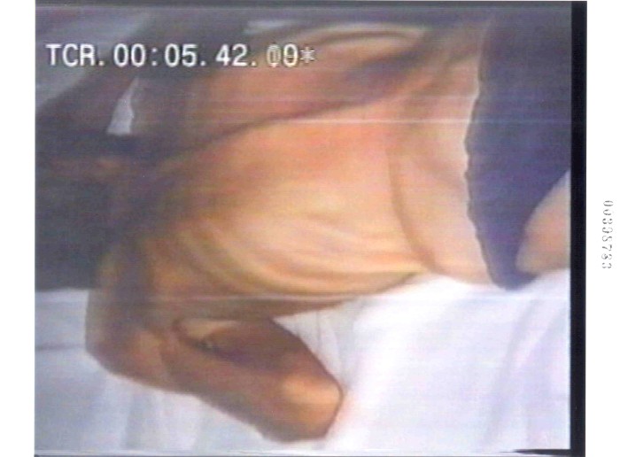 Covert images submitted to the British TV crew by Dr. Idriz Merdzanic from the Trnopolje concentration camp in August of 1992 during the Bosnian Genocide.